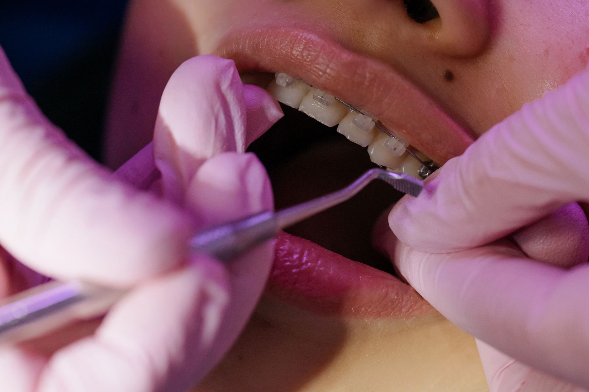 Orthodontic patient with braces smiling